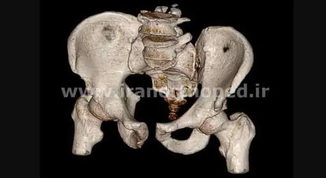 در رفتگی مفصل ساکروایلیاک و دیاستاز سمفیز پوبیس