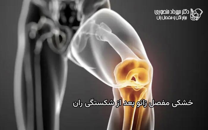 خشکس زانو بعد از شکستگی های استخوان ران را چگونه پیشگیری و درمان کنیم