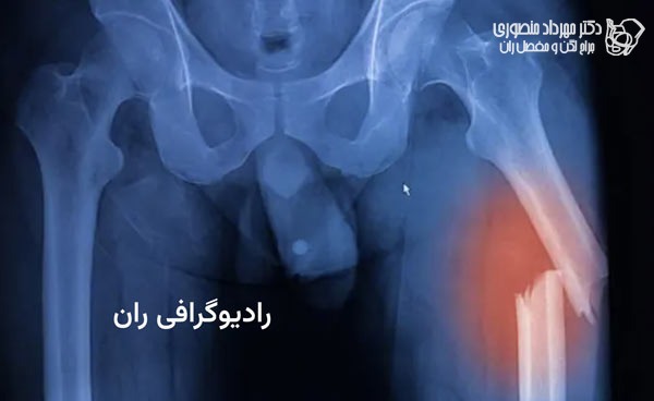 رادیوگرافی ران