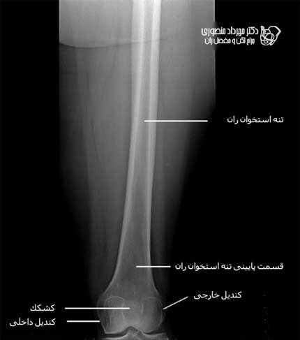  رادیوگرافی رخ قسمت های وسط و پایین ران