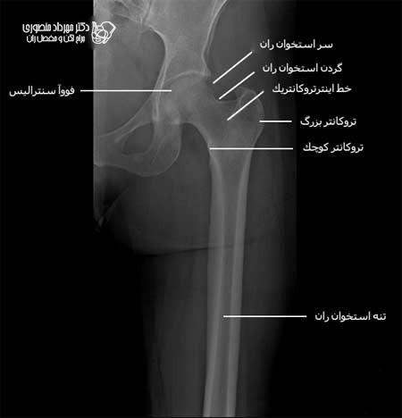  رادیوگرافی رخ قسمت های وسط و بالای ران