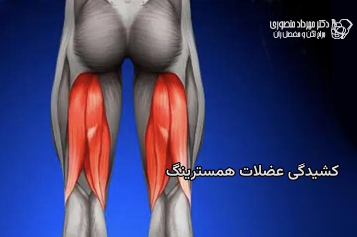 کشیدگی همسترینگ در پشت ران چگونه درمان میشود