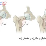 کوکسا وارا ی مادرزادی مفصل ران چیست