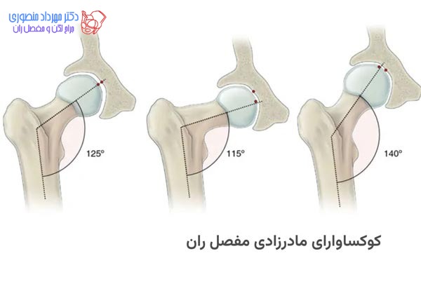کوکساوارا چیست و چه تفاوتی با کوکسا والگا دارد 1 کوکسا وارا ی مادرزادی مفصل ران چیست