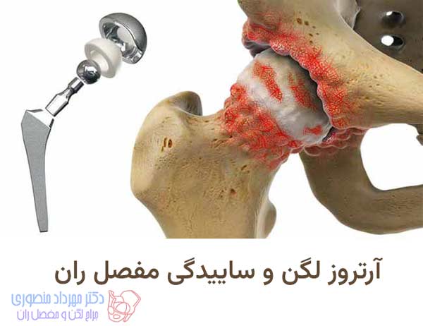 آرتروز لگن و ساییدگی مفصل ران