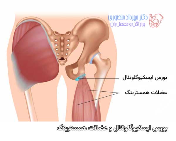 بورس ایسکیوگلوتئال و عضلات همسترینگ