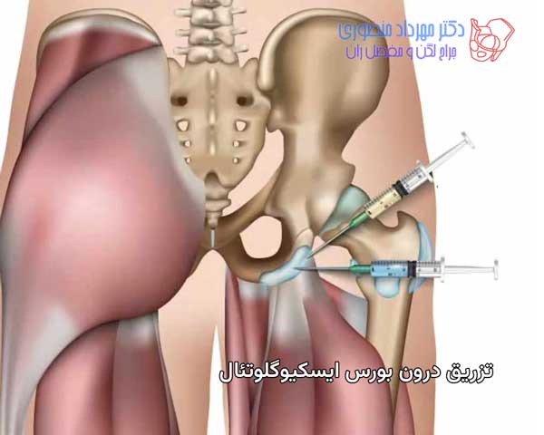 تزریق درون بورس ایسکیوگلوتئال