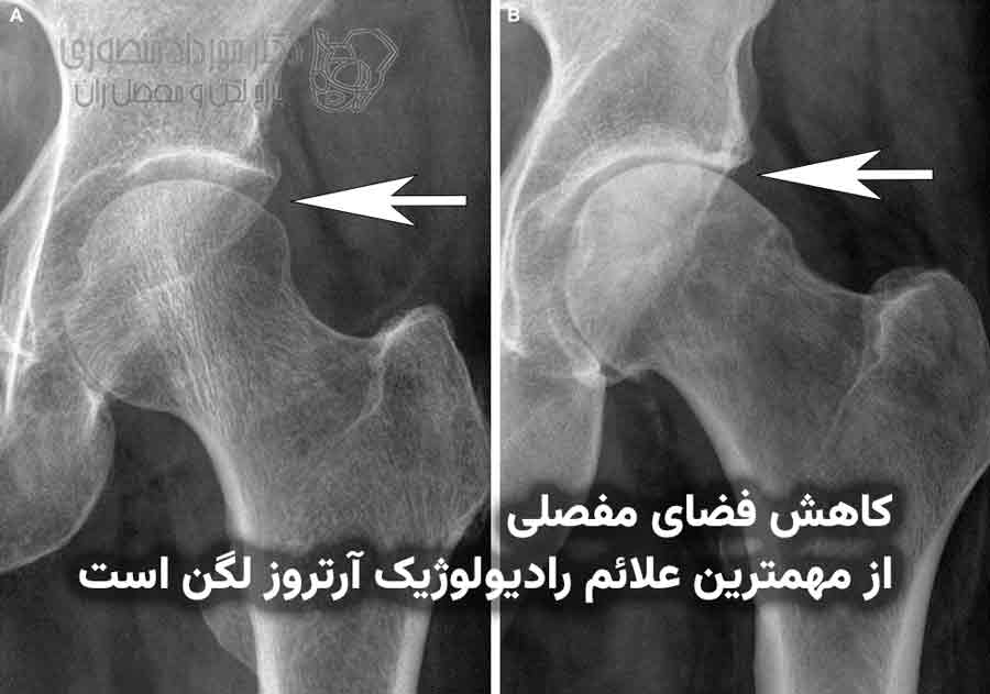 رادیولوژی لگن که کاهش فضای مفصل ران ناشی از ساییدگی مفصلی را نشان میدهد