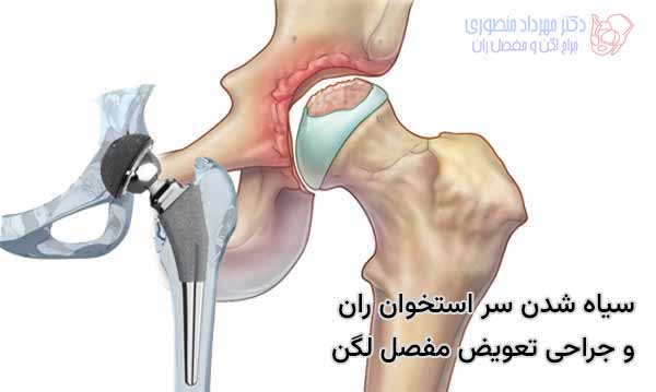 از درمان های مهم سیاه شدن استخوان لگن جراحی توتال هیپ است