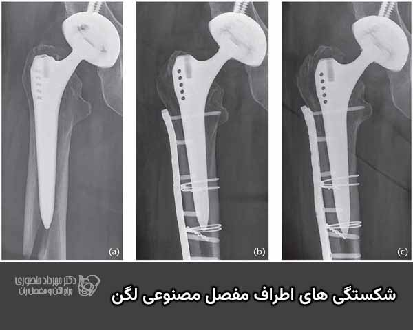 شکستگی های اطراف مفصل مصنوعی لگن چگونه درمان میشوند