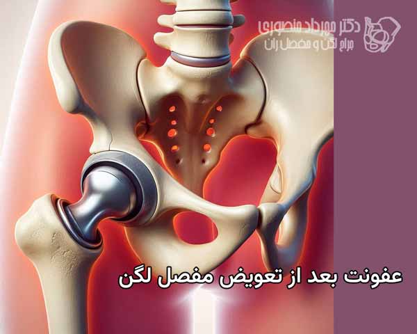 عفونت بعد از جراحی تعویض مفصل در ناحیه لگن چه عللی دارد و چگونه درمان میشود