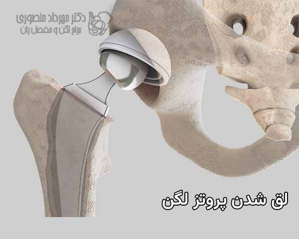 لق شدن و شل شدن پروتز گذاشته شده در ناحیه لگن چه عللی دارد و چگونه درمان میشود