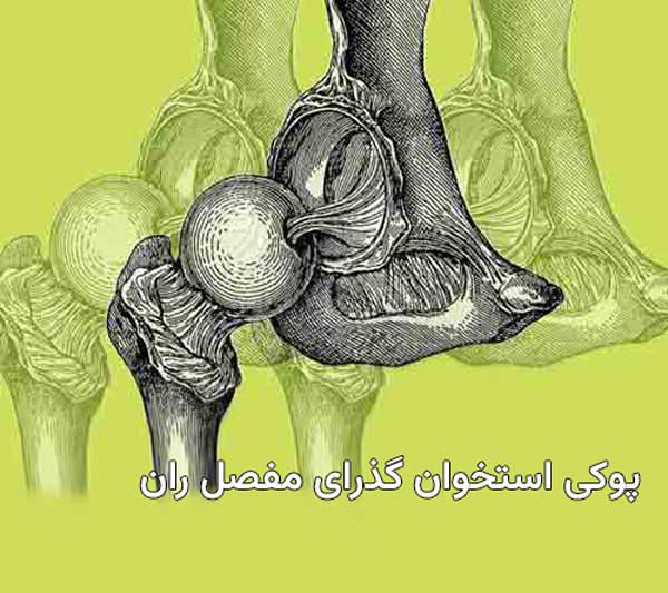 پوکی استخوان گذرای مفصل ران چیست و چه علائمی دارد