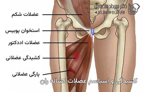 آسیب و پارگی عضلات اددکتور در کشاله ران