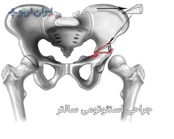 عمل جراحی استئوتومی سالتر برای درمان دررفتگی مادرزادی مفصل ران