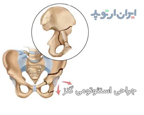 عمل جراحی استئوتومی گنز برا درمان دیسپلازی مفصل ران