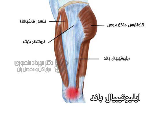 ایلیوتیبیال باند کجای لگن و ران است