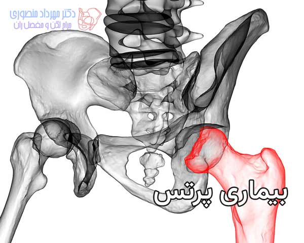 بیماری پرتس چیست. چه علت و علائمی دارد و چگونه درمان میشود