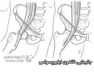 حرکت تاندون ایلیوپسواس و صدا دادن مفصل لگن