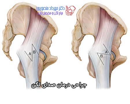 جراحی ایلیوتیبیال باند برای درمان اسنپ هیپ