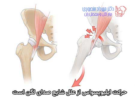 جابجایی تاندون ایلیوپسواس در جلوی مفصل ران