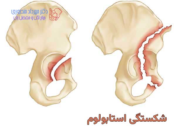 شکستگی استابولوم چگونه ایجاد میشود و درمان آن چیست