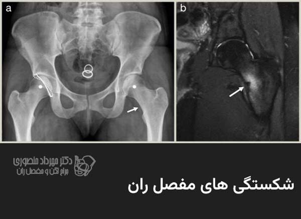 شکستگی مفصل ران چگونه درمان میشود