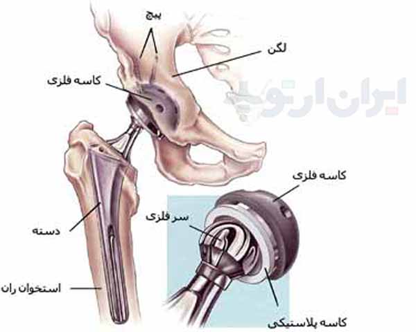 پروتز لگن چیست و چند نوع دارد 6 یگ پروتز ران و لگن