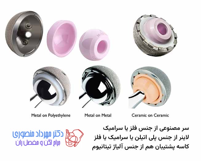 پروتز لگن چیست و چند نوع دارد 9 سر مصنوعی از فلز یا سرامیک و لاینر از پلی اتیلن است
