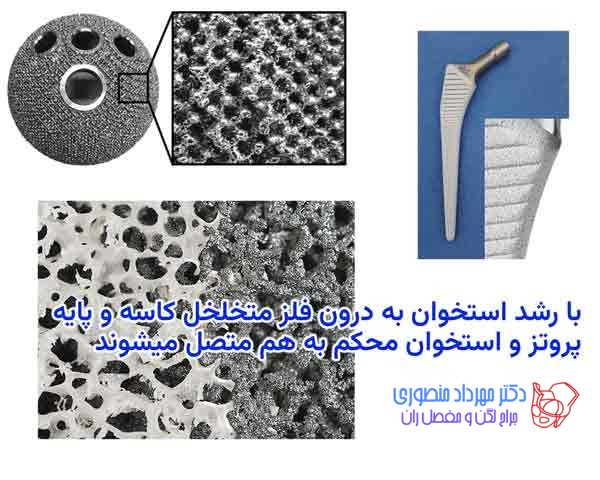پروتز لگن چیست و چند نوع دارد 12 اتصال استخوان به فلز متخلخل پروتز لگن