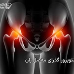 پوکی استخوان گذرای مفصل ران چیست