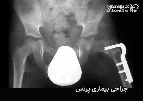 بیماری لگ کالو پرتس در کودکان. علائم، مراحل و درمان 10 روش جراحی بیماری پرتس چگونه است