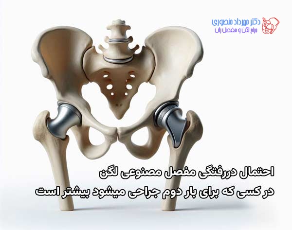 احتمال دررفتگی مفصل مصنوعی در جراحی دوم بیشتر است