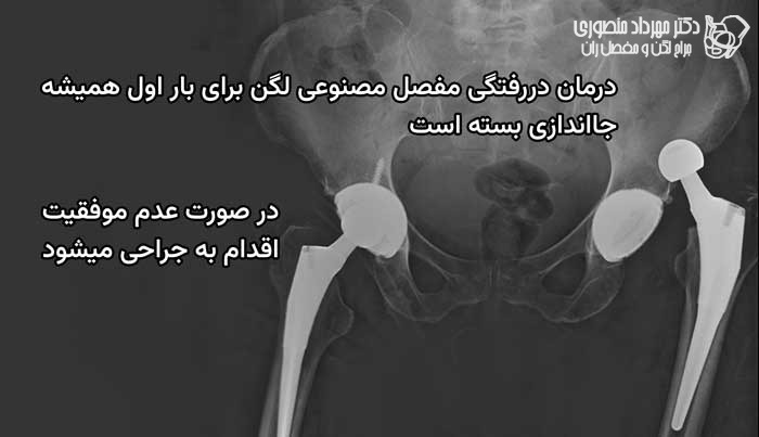 درمان دررفتگی مفاصل مصنوعی کار گذاشته شده در لگن