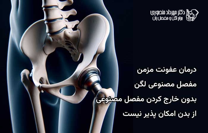 عفونت مفصل مصنوعی لگن، علائم و درمان 6 درمان عفونت مزمن مفصل مصنوعی همیشه شامل خارج کردن پروتز است