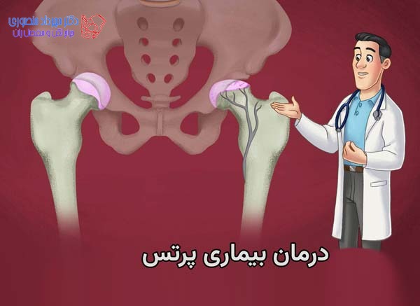 بیماری لگ کالو پرتس در کودکان. علائم، مراحل و درمان 7 هدف درمان بیماری پرتس در کودکان چیست
