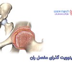 سینوویت گذرای مفصل ران
