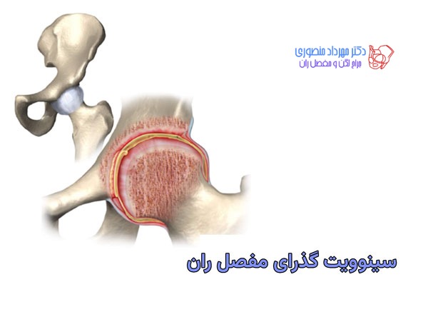 سینوویت گذرای مفصل ران در بچه ها یا آب آوردن مفصل لگن در کودکان 1 سینوویت گذرای مفصل ران