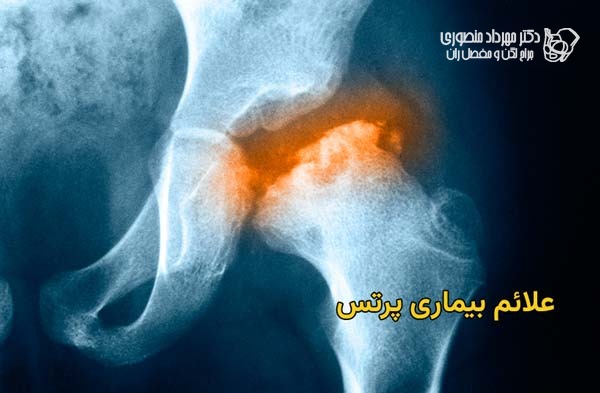 بیماری لگ کالو پرتس در کودکان. علائم، مراحل و درمان 4 علائم بیماری پرتس چیست