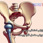 عوارض احتمالی جراحی تعویض مفصل در ناحیه لگن چیست