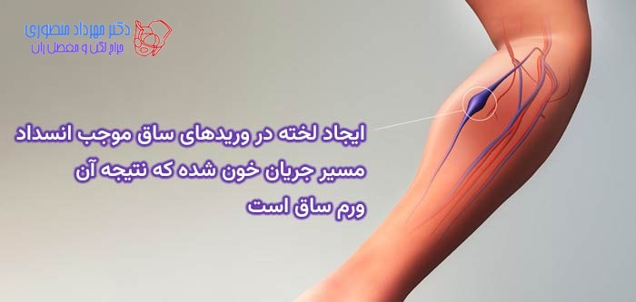 ایجاد لخته در وریدهای ساق موجب انسداد مسیر جریان خون شده که نتیجه آن ورم ساق است