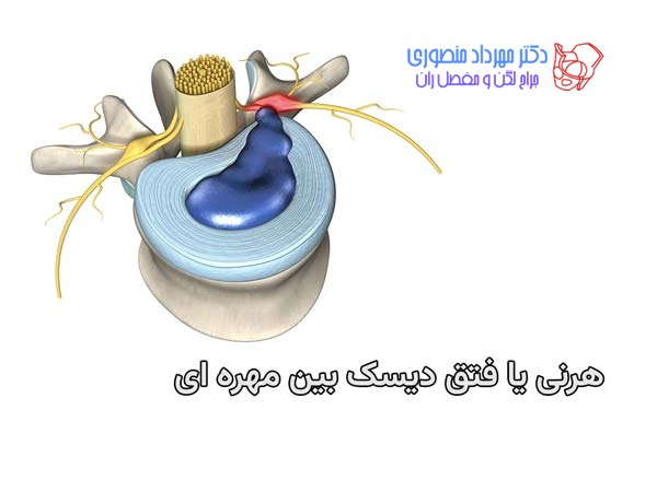 هرنی یا فتق دیسک بین مهره ای