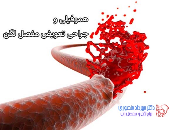 جراحی تعویض مفصل لگن در بیماران هموفیلی و آرتروپاتی هموفیلیک 1 هموفیلی و جراحی تعویض مفصل