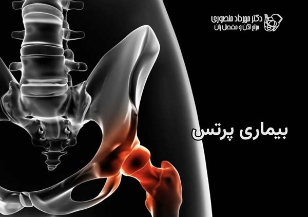 بیماری پرتس چیست