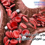 کم خونی داسی شکل و جراحی تعویض مفصل