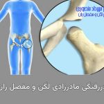 دررفتگی لگن مادرزادی