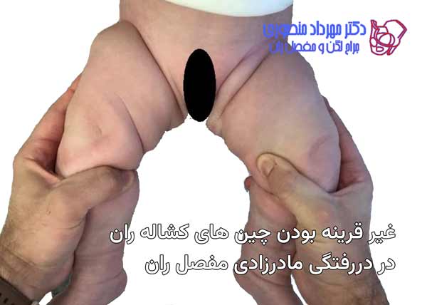 چین های کشاله ران غیر قرینه از علائم دررفتگی مادرزادی لگن است