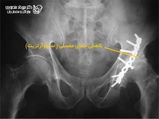 آرتروز و ساییدگی بعد از شکستگی استابولوم لگن