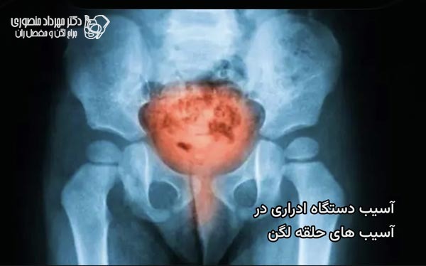 آسیب دستگاه ادراری بعد از آسیب و شکستگی حلقه لگن