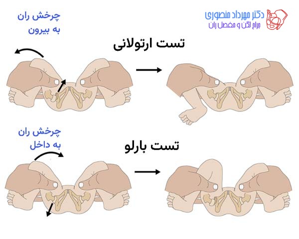 عکس دررفتگی لگن نوزاد. تست ارتولانی و بارلو برای تشخیص دررفتگی مادرزادی لگن و مفصل ران در نوزادان